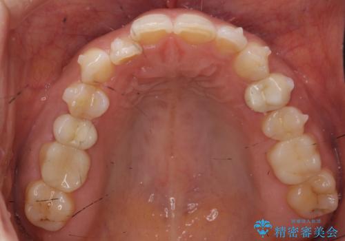前歯が引っ込んでいる　下の歯のがたがたを　インビザラインでの治療中