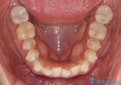 前歯が引っ込んでいる　下の歯のがたがたを　インビザラインでの治療中