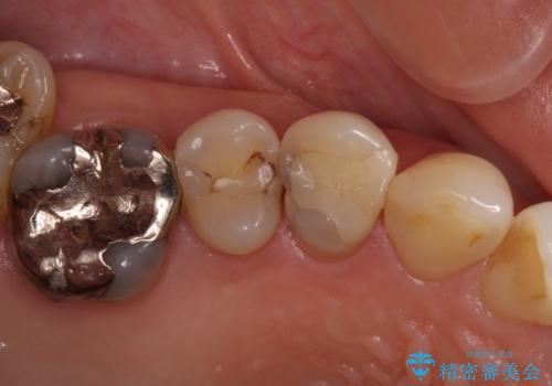 大きくなった虫歯のセラミック治療の治療前