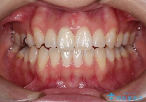 前歯の白濁が気になる　オールセラミッで審美的改善の治療後