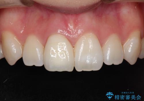 前歯の白濁が気になる　オールセラミッで審美的改善の症例 治療後