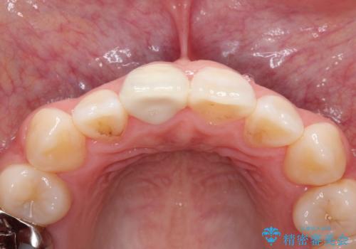 前歯の白濁が気になる　オールセラミッで審美的改善の治療後