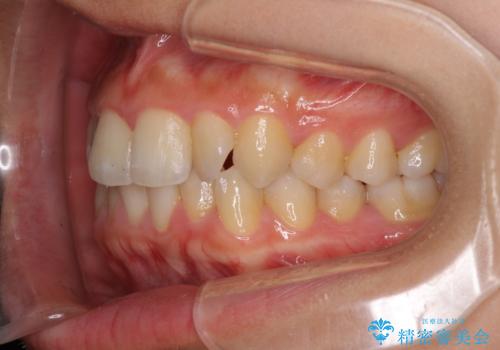 前歯のデコボコを治したい　インビザラインによる非抜歯矯正治療の治療前