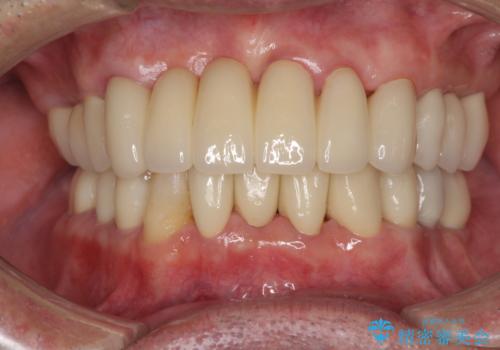 ボロボロの歯を何とかしたい　総合歯科治療による全顎治療の症例 治療後