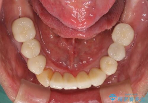 ボロボロの歯を何とかしたい　総合歯科治療による全顎治療の治療後