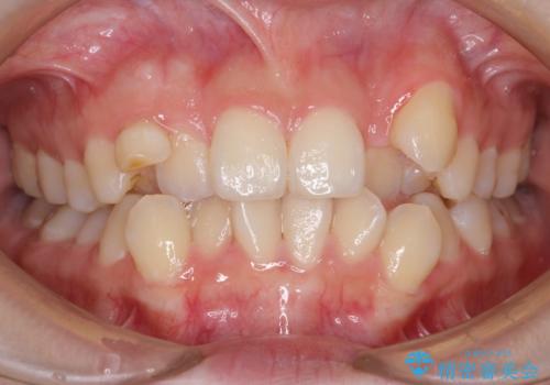 八重歯　ハーフリンガルで　乳歯が残っているの症例 治療前