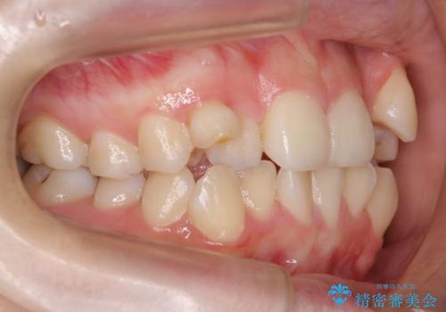 八重歯　ハーフリンガルで　乳歯が残っているの治療前