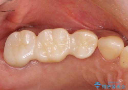 分岐部病変の奥歯→一見問題なさそうだが、抜歯しなければならないの症例 治療後