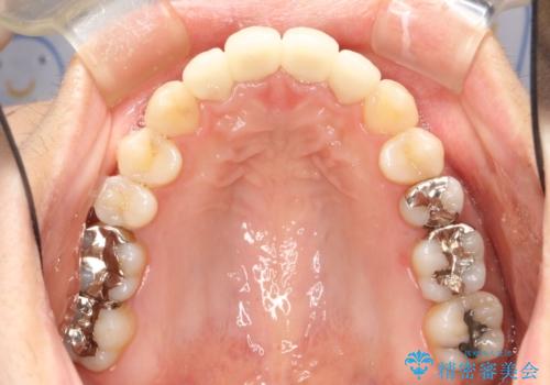 出っ歯が気になる　オープンバイトを伴う前突症のインビザライン治療・セラミック治療　invisalignの治療後