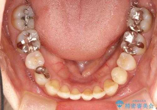 出っ歯が気になる　オープンバイトを伴う前突症のインビザライン治療・セラミック治療　invisalignの治療後