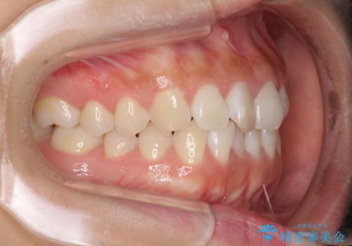 前歯のデコボコをお手軽に治したい　インビザライン・ライトによる矯正治療の治療前