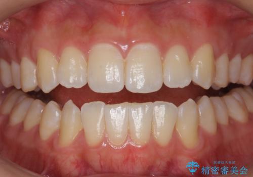 PMTCエクセレントコースで歯を白くきれいにの治療前