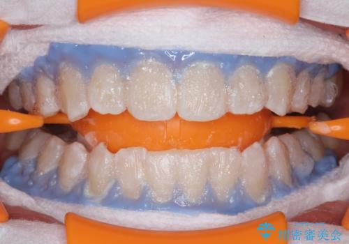 PMTCエクセレントコースで歯を白くきれいにの治療中