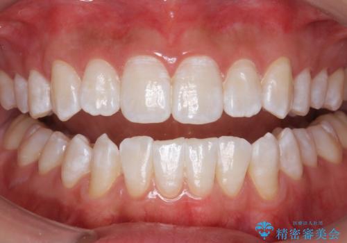 PMTCエクセレントコースで歯を白くきれいにの症例 治療後