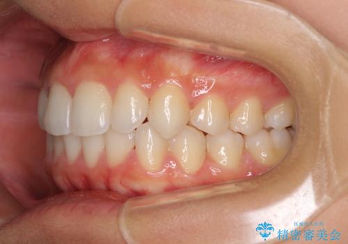 前歯のデコボコを治したい　インビザラインによる非抜歯矯正治療の治療後