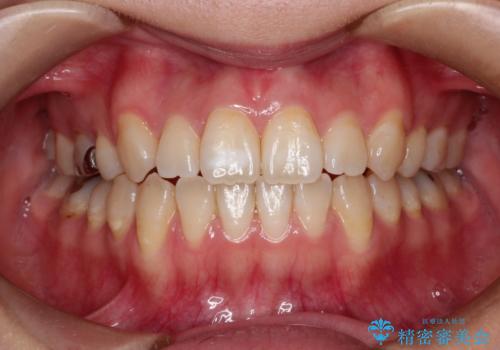 前歯の白濁が気になる　オールセラミッで審美的改善の治療前