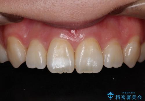 前歯の白濁が気になる　オールセラミッで審美的改善の症例 治療前