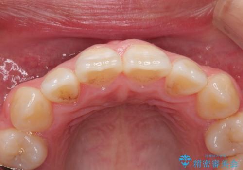 前歯の白濁が気になる　オールセラミッで審美的改善の治療前