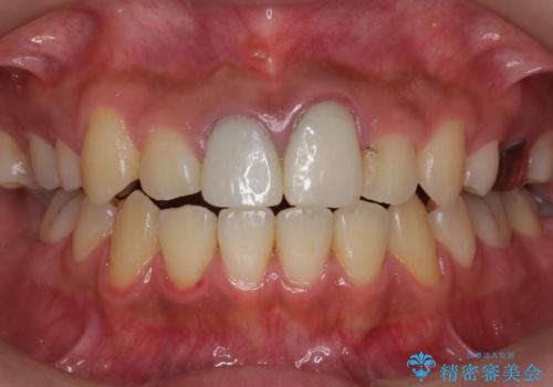 ホワイトニングエクセレントコースで歯を白く。1回目の治療前