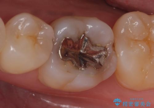 セラミックインレー　銀歯を白くの症例 治療前