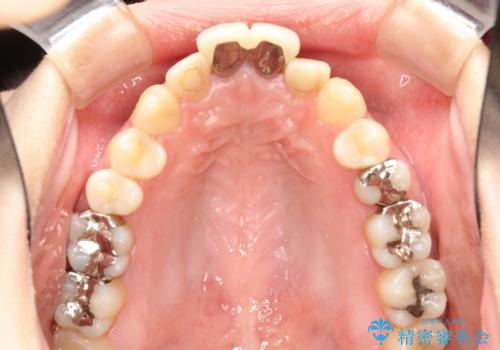 出っ歯が気になる　オープンバイトを伴う前突症のインビザライン治療・セラミック治療　invisalign