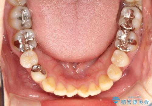 出っ歯が気になる　オープンバイトを伴う前突症のインビザライン治療・セラミック治療　invisalignの治療前