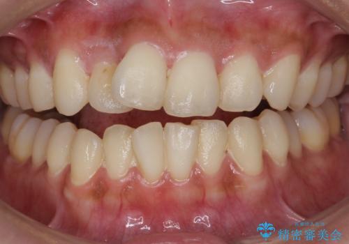 クリーニングとホワイトニングエクセレントコースで歯を白くきれいに。の症例 治療前