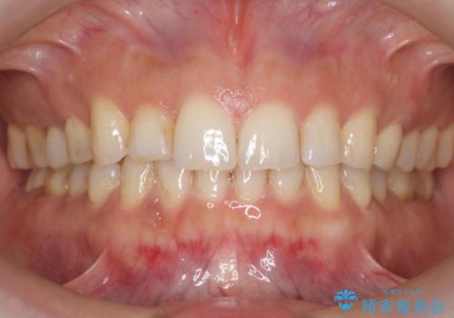 前歯が引っ込んでいる　下の歯のがたがたを　インビザラインでの症例 治療後