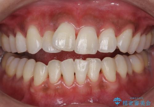 クリーニングとホワイトニングエクセレントコースで歯を白くきれいに。の症例 治療後