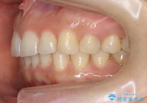 前歯が引っ込んでいる　下の歯のがたがたを　インビザラインでの治療後
