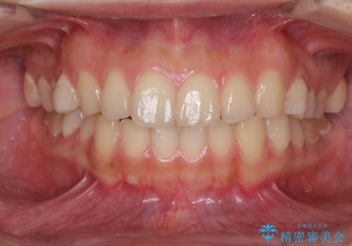 インビザラインで前歯のガタつきの改善の治療前