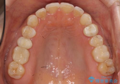 前歯が引っ込んでいる　下の歯のがたがたを　インビザラインでの治療後
