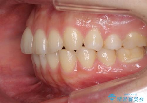 インビザラインで前歯のガタつきの改善の治療前