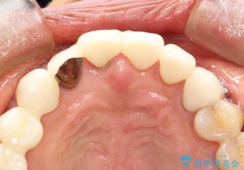 前歯のかぶせものの下に巨大な虫歯が　ぎりぎり抜歯をまぬがれるにはの治療前