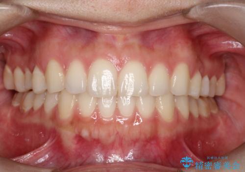 インビザラインで前歯のガタつきの改善の治療後