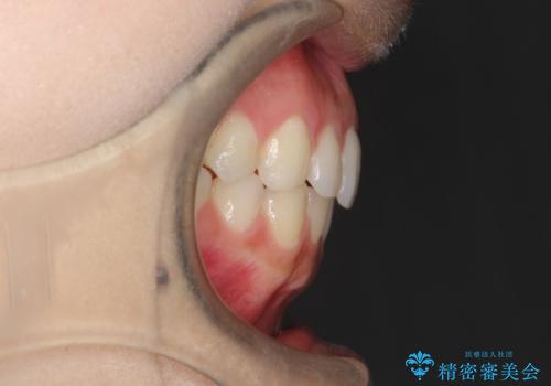インビザラインで前歯のガタつきの改善の治療後