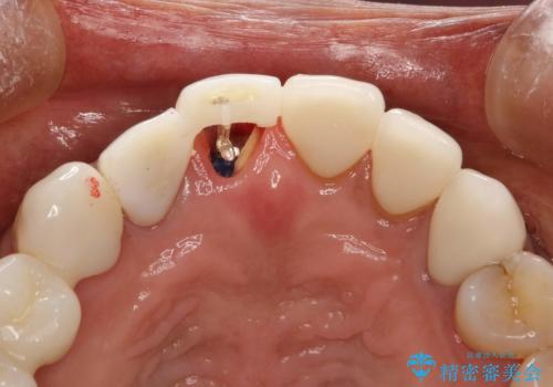 前歯のかぶせものの下に巨大な虫歯が　ぎりぎり抜歯をまぬがれるにはの治療中