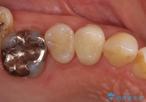 大きくなった虫歯のセラミック治療の症例 治療後