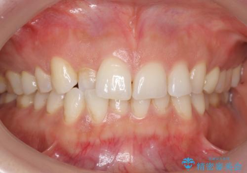 前歯が引っ込んでいる　下の歯のがたがたを　インビザラインでの症例 治療前