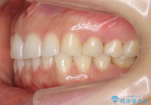 前歯が引っ込んでいる　下の歯のがたがたを　インビザラインでの治療前