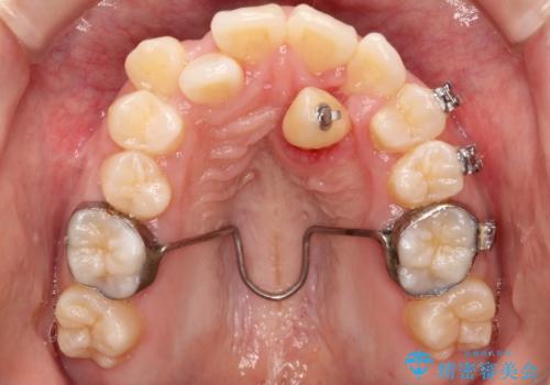 埋まった歯を出してくる矯正治療(牽引から萌出するまで)の症例 治療後