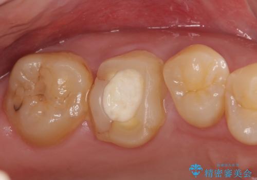 オールセラミッククラウン　歯茎より深い虫歯(縁下カリエス)の治療の症例 治療前