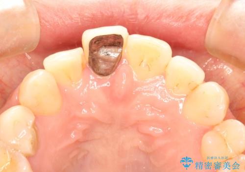 金属製の前歯をメタルフリーにしたい　単独前歯のセラミック処理の症例 治療前