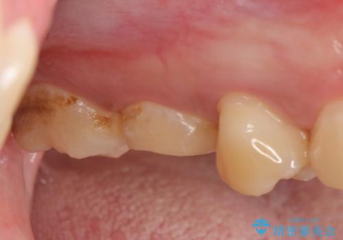 オールセラミッククラウン　歯茎より深い虫歯(縁下カリエス)の治療の治療前