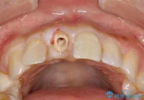 金属製の前歯をメタルフリーにしたい　単独前歯のセラミック処理の治療中