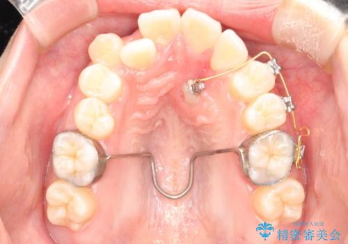 埋まった歯を出してくる矯正治療(牽引から萌出するまで)の治療中