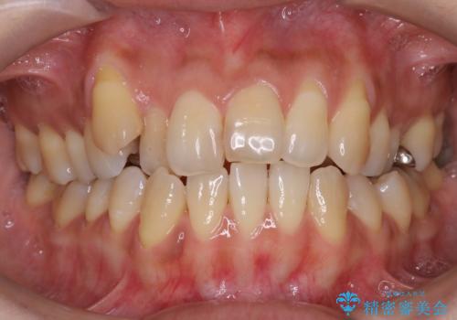 八重歯と反対咬合、下の前歯が1本少ない　インビザラインによる非抜歯治療　invisalignの症例 治療前