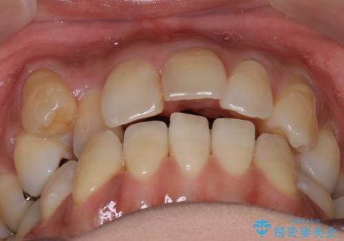 八重歯と反対咬合、下の前歯が1本少ない　インビザラインによる非抜歯治療　invisalignの治療前