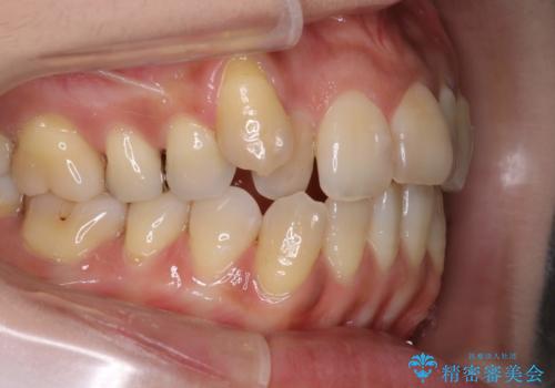 八重歯と反対咬合、下の前歯が1本少ない　インビザラインによる非抜歯治療　invisalign