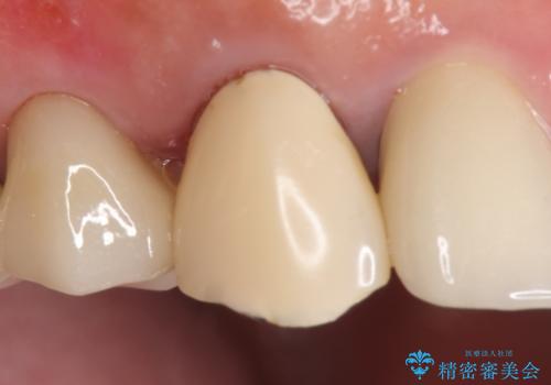オールセラミッククラウン　歯と被せ物の隙間にできた虫歯の治療の治療前